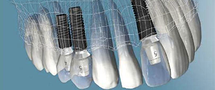 implantes dentales en Gijón
